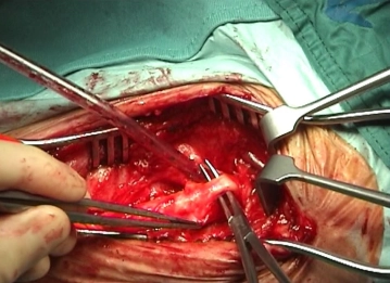 Dissecting the carotid bifurcation, mobilizing the hypoglossal nerve
