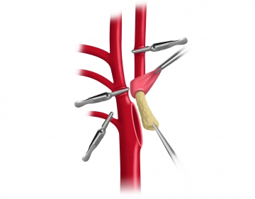 Cross-clamping the carotid bifurcation, EEA of ICA and TEA of carotid bifurcation