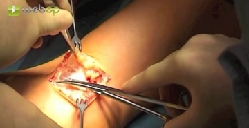 Access in the right cubital fossa