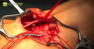 Preparación de la V. cephalica