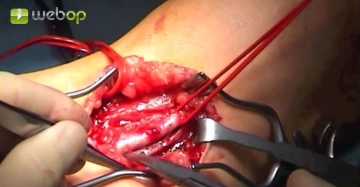  Dissecting the brachial artery