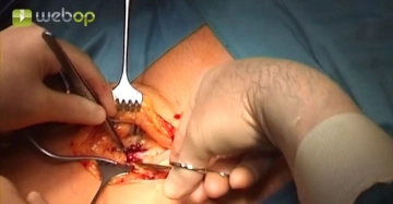 Exposición de la A. femoralis superficialis