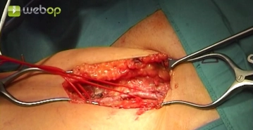 Exposing the common femoral artery
