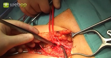 Exposing the deep femoral artery