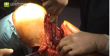 Acceso a los vasos femorales