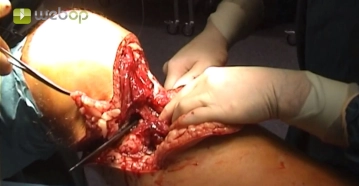 Formación del colgajo cutáneo-muscular posterior (flexores de la rodilla, aductores) con método de transfixión