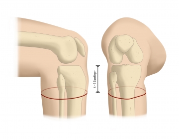 Incising the skin and fashioning a full-thickness tube