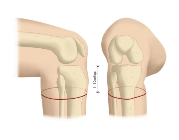 Incising the skin and fashioning a full-thickness tube