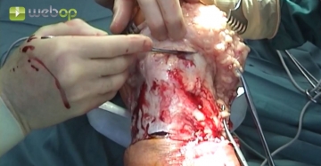 Dividing the patellar ligament, collateral ligaments and joint capsule medially and laterally