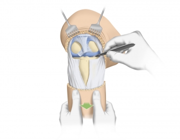 Transecting the cruciate ligaments