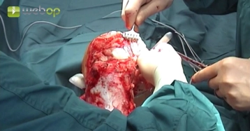 Transecting the posterior knee joint capsule