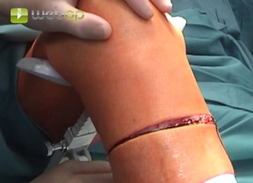 Special instruments and fixation systems