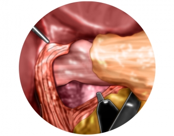 Mediastinal mobilization of the distal esophagus