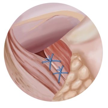 Posterior hiatoplasty