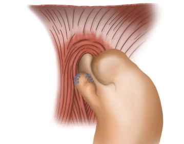 Fixation of the fundus cuff I