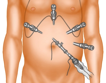 Laparoscopic Toupet fundoplication