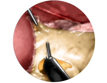 Extending the stomach and incising the omentum