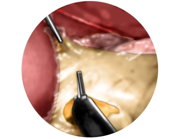 Traction of the stomach and incision of the lesser omentum