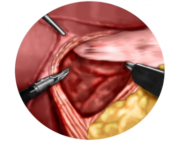Exposing the diaphragmatic crura and entering the mediastinum