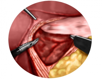 Exposing the left crus of the diaphragm