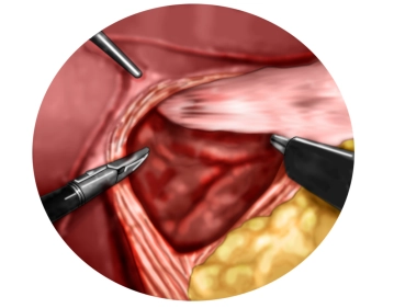 Dissection of the left diaphragmatic crus with entry into the mediastinum