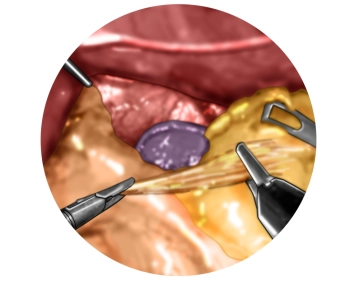 Mobilization of the gastric fundus