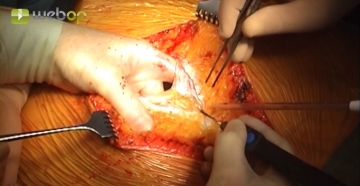  Laparotomy