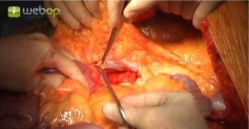 Opening the retroperitoneum