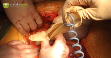 Locating the superior mesenteric artery