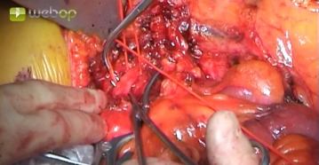 Exposing the superior mesenteric artery