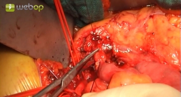Dividing the inferior mesenteric vein and exposing the infrarenal aorta