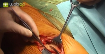 Exposing the femoral bifurcation, right groin