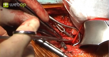Attempted thrombectomy of popliteal artery segment P1