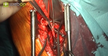 Infrapopliteal exposure of popliteal artery segment P3