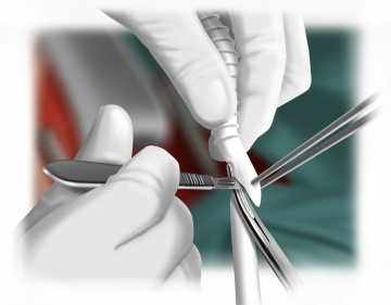 Preparing the PTFE graft