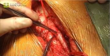 Exposing the femoral bifurcation, right groin