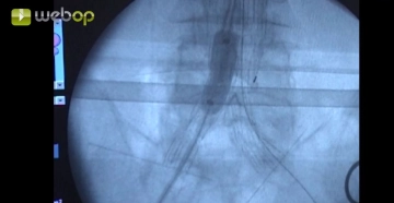 Molding the graft modules