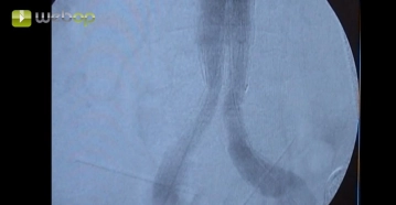 Verification angiography