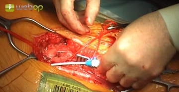 Puncturing the left common femoral artery, introducing a 6F sheath in Seldinger technique and placing a guidewire