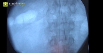 3. Puncturing the right common femoral artery, introducing a 6F sheath in Seldinger technique and placing a guidewire
