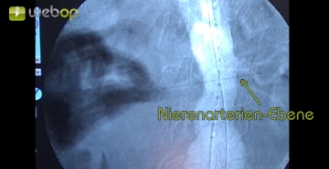 Inserting a pigtail catheter on the left, extracorporal marking of renal artery level