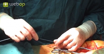 Switching the pigtail catheter from left to right, inserting a stiff guidewire into the thoracic aorta