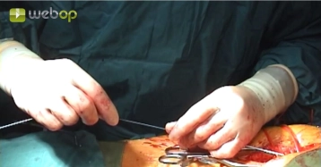 Switching the pigtail catheter from left to right, inserting a stiff guidewire into the thoracic aorta