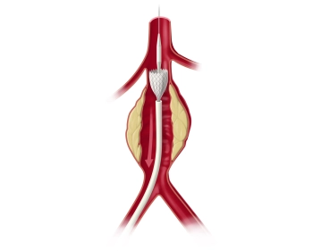 Introducing the main body via the right groin