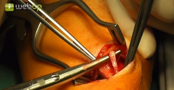 Dissecting the cephalic vein