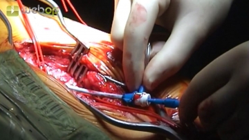 Exposing the left groin and puncturing the common femoral artery