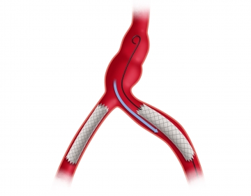 Probing the left iliac arteries, exploratory angiography
