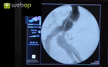 Positioning the endograft