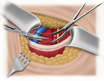 Transecting the anterior scalene muscle