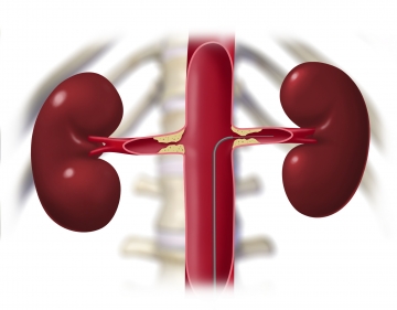 Intraoperative angiography, probing the left renal artery